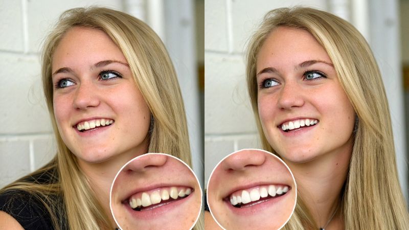 cover photo-3 Best Teeth Whitening Apps