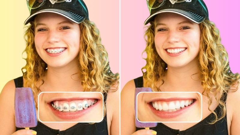 No Braces Filter: What Will I Look Like without Braces?