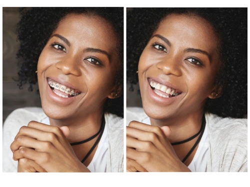 No-Brace Filter - Retouchme before after