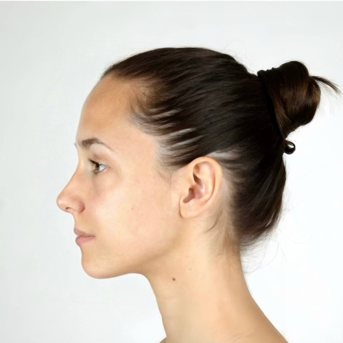 Nose Job Filter - side after